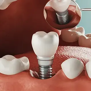 Model of a dental implant